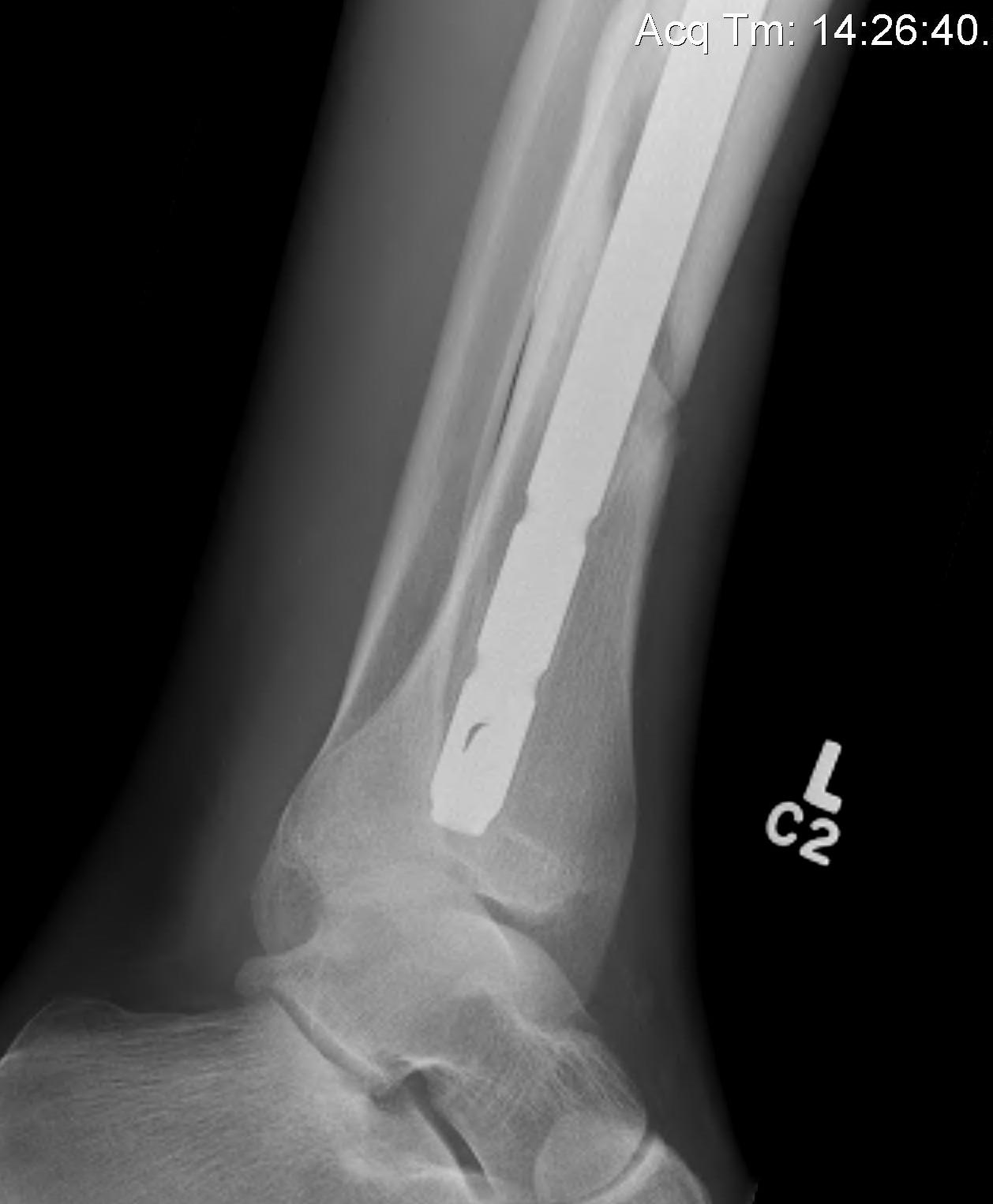 Distal Tibial Nail Lateral